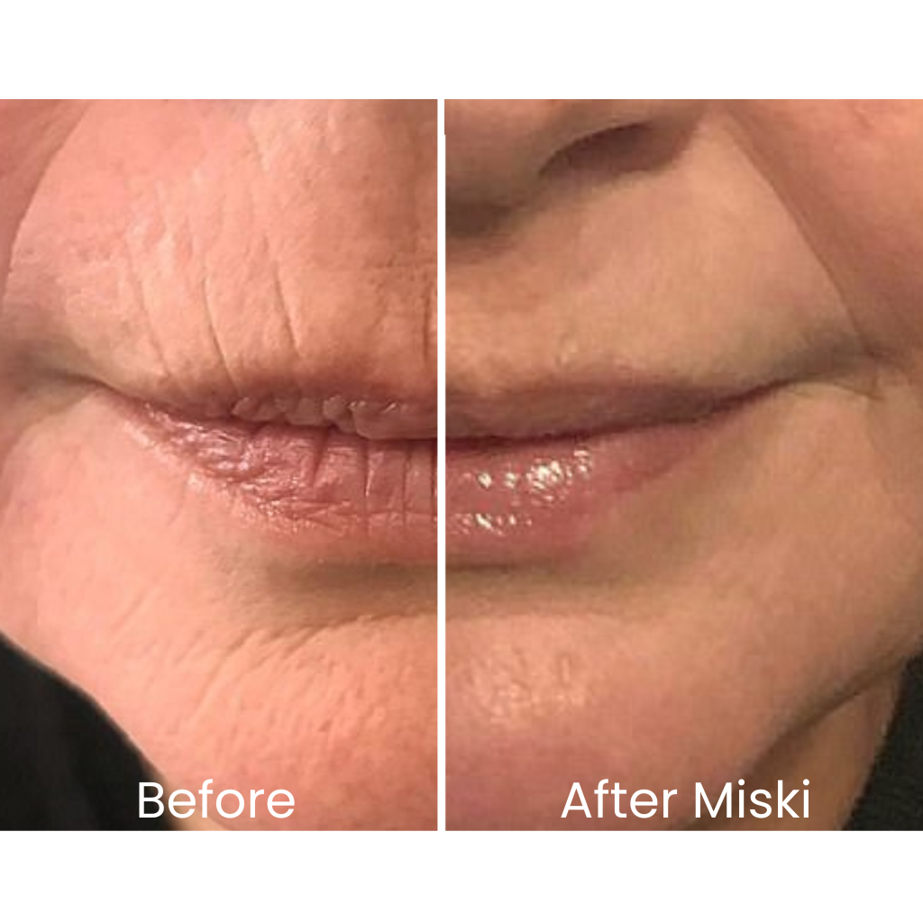 Miski Micro Infusion-System ENG