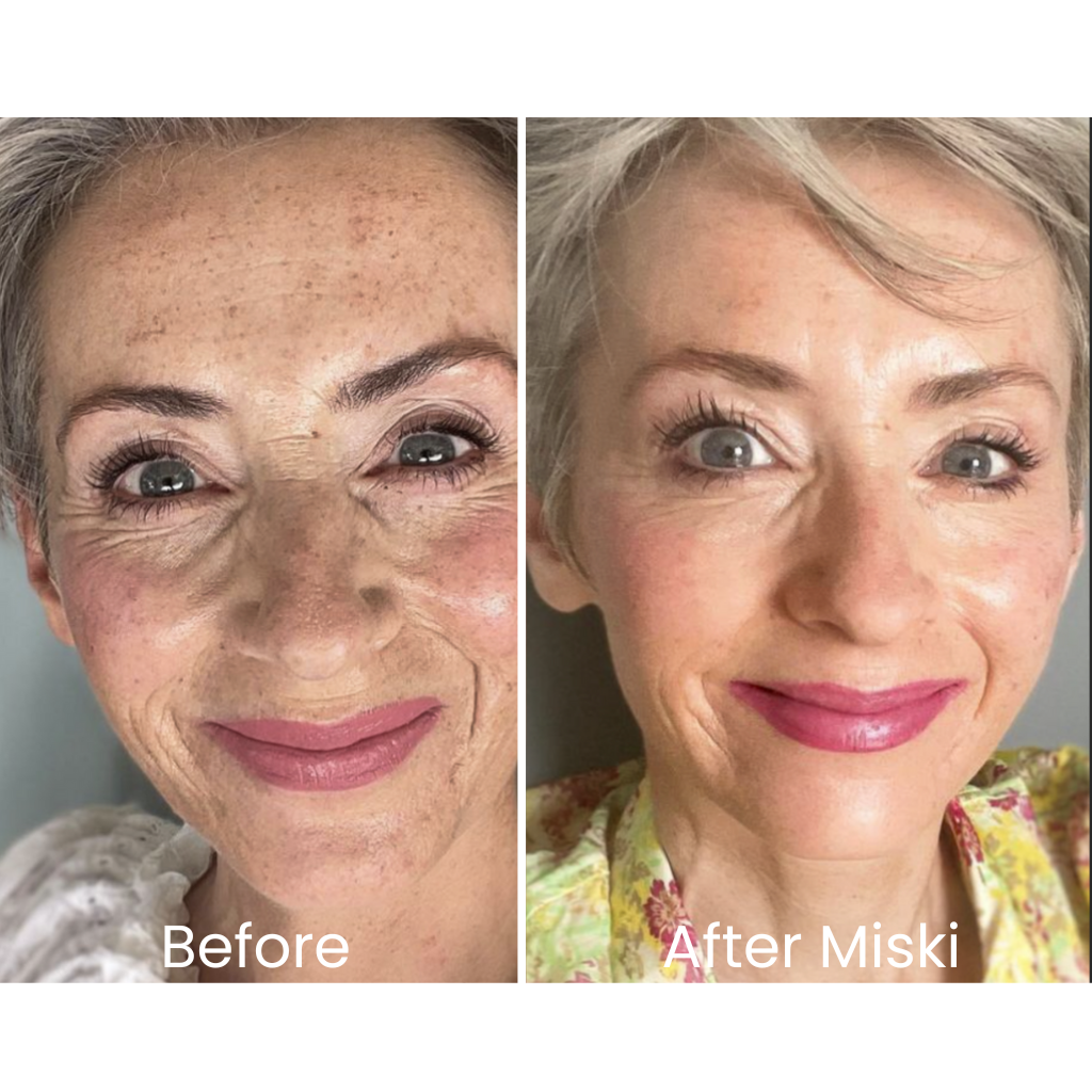 Miski Micro Infusion-System ENG