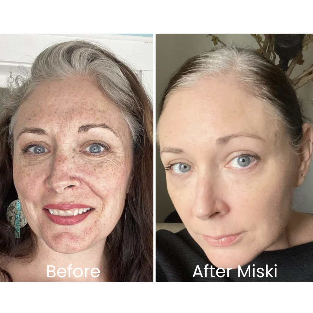 Miski Micro Infusion-System ENG