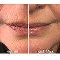 Miski Micro Infusion System
